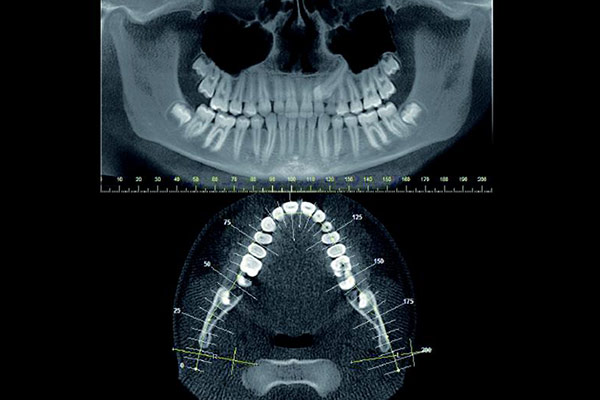3D-Röntgen für HNO – Professor Lindorf, PD von Wilmowsky und Kollegen – Mund Kiefer Gesicht Chirurgie Nürnberg