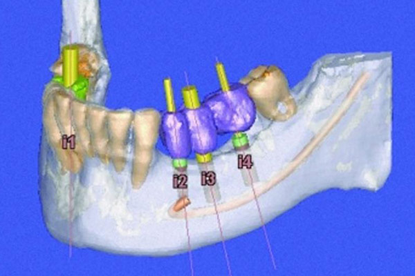 3D-Röntgen in der Implantologie – Professor Lindorf, PD von Wilmowsky und Kollegen – Mund Kiefer Gesicht Chirurgie Nürnberg