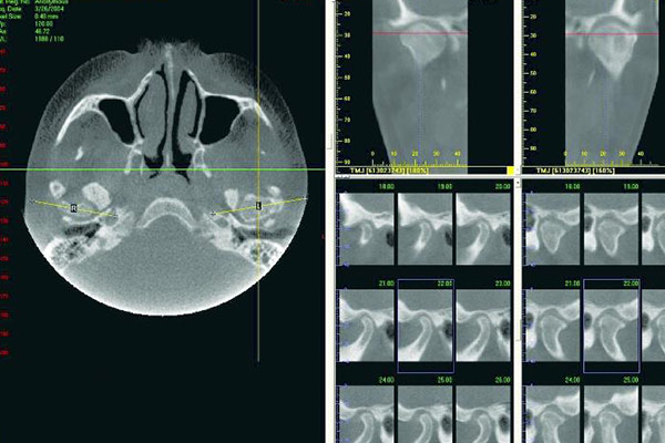 3D-Röntgen in der Kiefergelenkdiagnostik – Professor Lindorf, PD von Wilmowsky und Kollegen – Mund Kiefer Gesicht Chirurgie Nürnberg