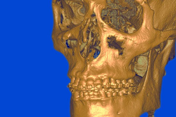 3D-Röntgen in der Kieferorthopädie – Professor Lindorf, PD von Wilmowsky und Kollegen – Mund Kiefer Gesicht Chirurgie Nürnberg