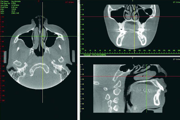 3D-Röntgen in der Schlafmedizin – Professor Lindorf, PD von Wilmowsky und Kollegen – Mund Kiefer Gesicht Chirurgie Nürnberg