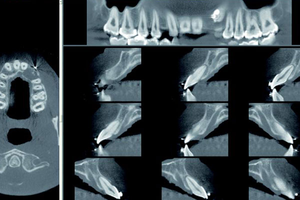 3D-Röntgen in der Zahnmedizin – Professor Lindorf, PD von Wilmowsky und Kollegen – Mund Kiefer Gesicht Chirurgie Nürnberg