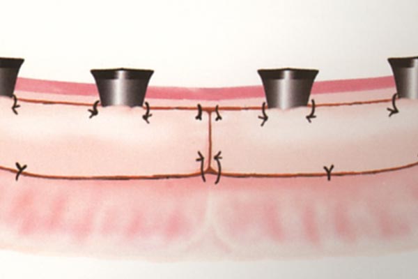 Schleimhauttransplantate vom Gaumen verbreitern das befestigte Zahnfleisch um die Implantate und vertiefen den Mundvorhof – Professor Lindorf, PD von Wilmowsky und Kollegen – Mund Kiefer Gesicht Chirurgie Nürnberg