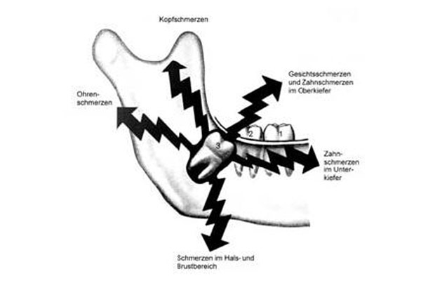 Schmerzen durch Weisheitszähne – Professor Lindorf, PD von Wilmowsky und Kollegen – Mund Kiefer Gesicht Chirurgie Nürnberg