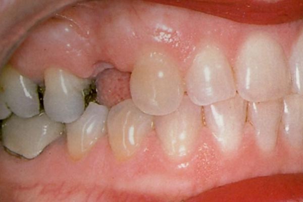 Typischer Gewebedefekt nach einem Zahnverlust im Oberkiefer – Professor Lindorf, PD von Wilmowsky und Kollegen – Mund Kiefer Gesicht Chirurgie Nürnberg