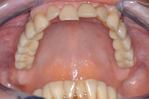 Implantat im rechten Unterkiefer und festem Zahnersatz – Professor Lindorf, PD von Wilmowsky und Kollegen – Mund Kiefer Gesicht Chirurgie