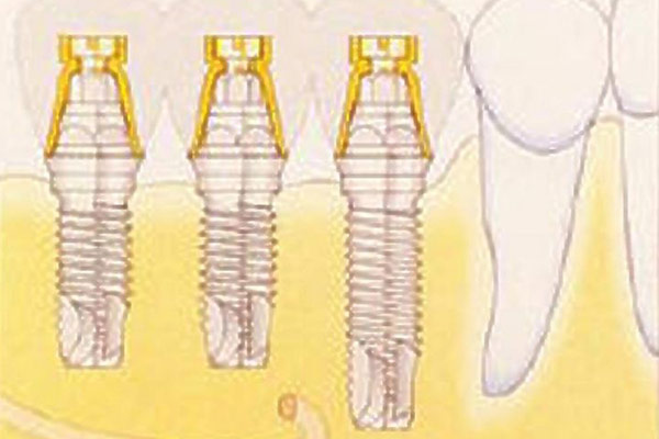 Schema eines implantatgestützten Zahnersatzes bei einer verkürzten Zahnreihe im Unterkiefer – Professor Lindorf, PD von Wilmowsky und Kollegen – Mund Kiefer Gesicht Chirurgie Nürnberg