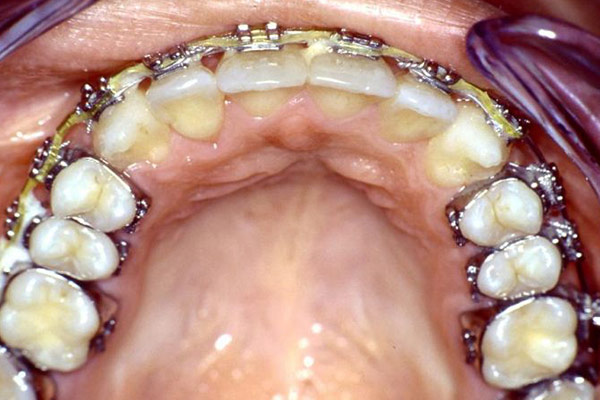 Gut ausgeformter Zahnbogen: Einordnen aller Zähne möglich – Professor Lindorf, PD von Wilmowsky und Kollegen – Mund Kiefer Gesicht Chirurgie Nürnberg