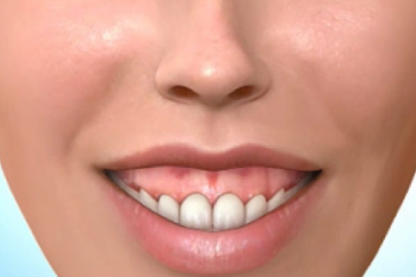 Gummy Smile vor der Korrektur – Professor Lindorf, PD von Wilmowsky und Kollegen – Mund Kiefer Gesicht Chirurgie Nürnberg