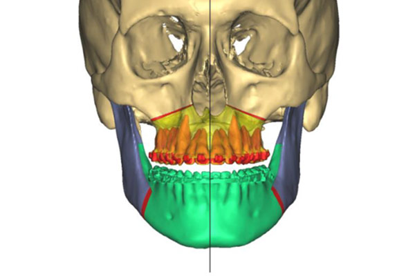 Computergestützte 3D-Planung – Professor Lindorf, PD von Wilmowsky und Kollegen – Mund Kiefer Gesicht Chirurgie Nürnberg