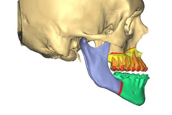 Computergestützte 3D-Planung – Professor Lindorf, PD von Wilmowsky und Kollegen – Mund Kiefer Gesicht Chirurgie Nürnberg
